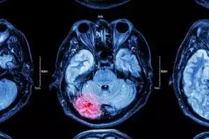 Lesiones Cerebrales Traumáticas