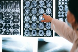 Cuatro tipos de lesiones cerebrales traumáticas